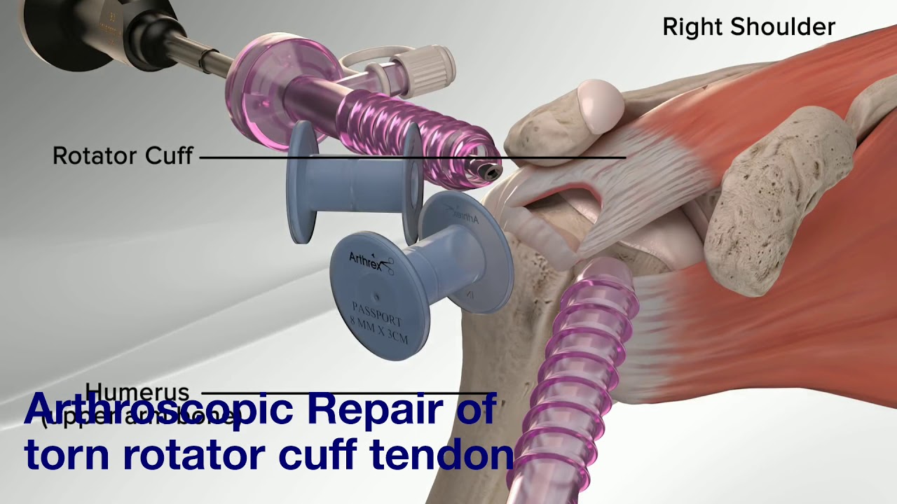Arthroscopic Rotator Cuff Repair (Animation)