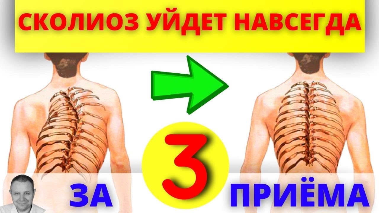 Вся правда о сколиозе. Сколиоз не приговор! Доктор Аверьянов рекомендует.