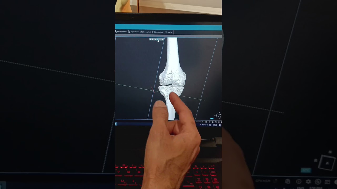 Implant planning in Robotic Knee Replacement
