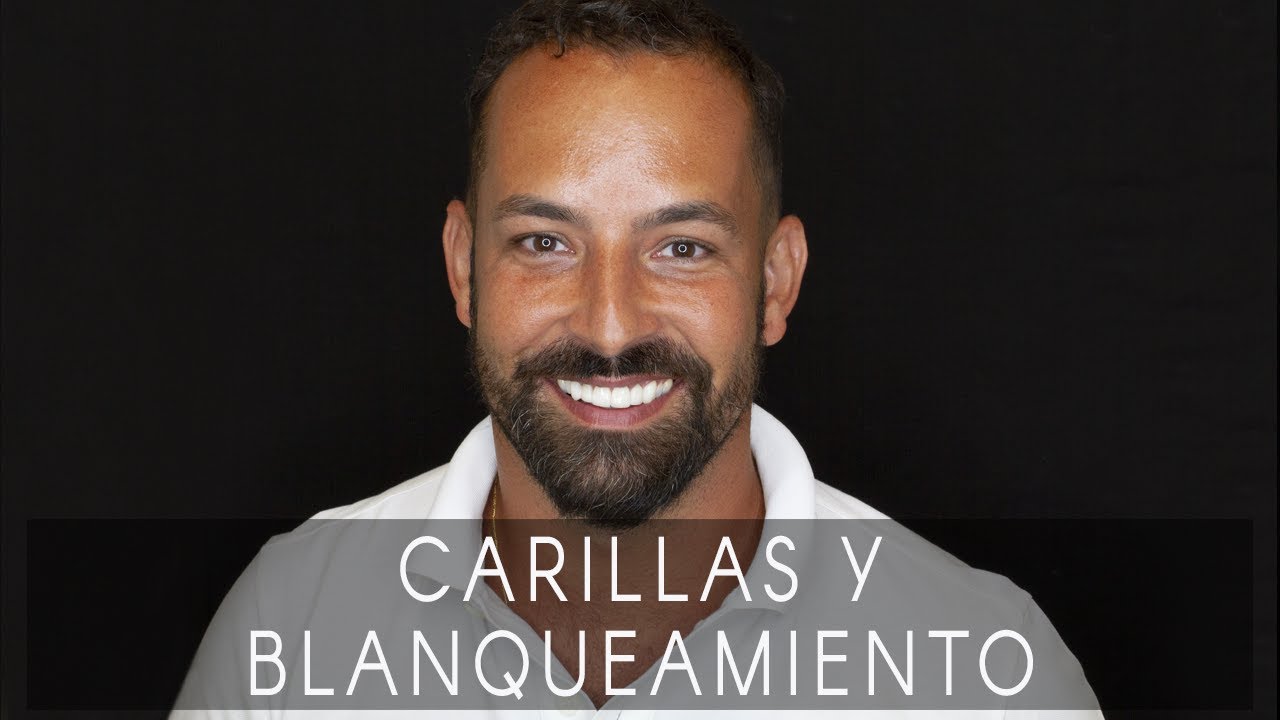 La sonrisa de Tiago: carillas y blanqueamiento dental