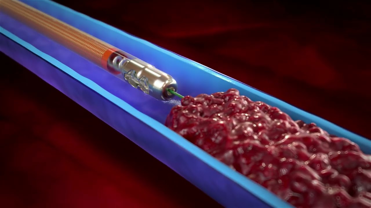 Aspirex™ Mechanical Aspiration Thrombectomy System Set Up