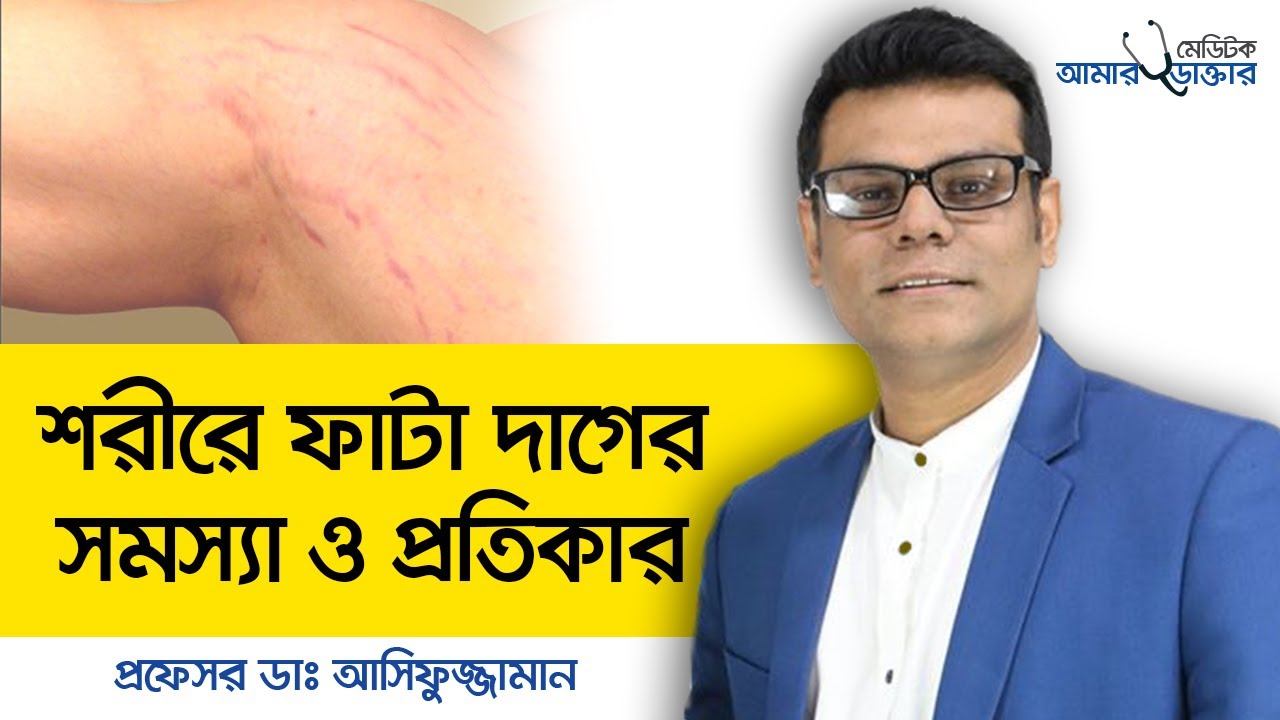 শরীরের ফাটা দাগ দূর করার উপায় - শরীরের দাগ দূর করার উপায় - ফাটা দাগ দূর করার উপায়