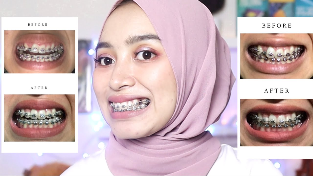 Update Pasang Behel Setelah 3 Bulan ll Tambah Sakit?