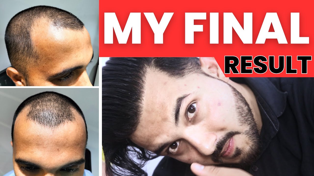 Journey Of My Full Hair Transplant Result After 1 Year || Best Hair Transplant Result In India 2023