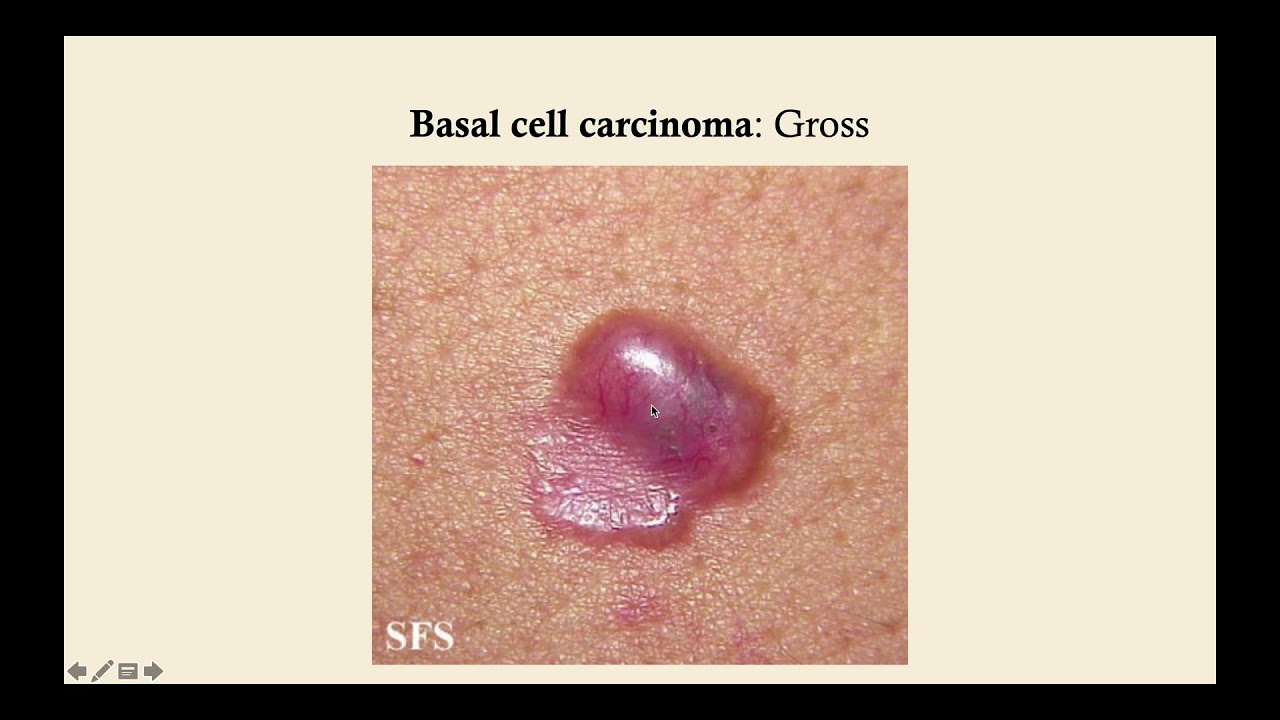 Basal Cell Carcinoma - CRASH! Medical Review Series