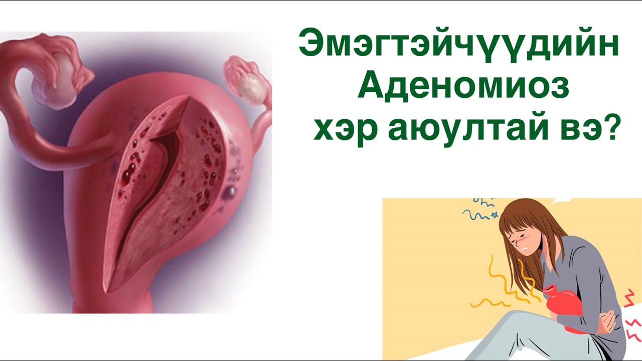 умайн салст хэт зузаарах эмгэг гэж юу вэ?