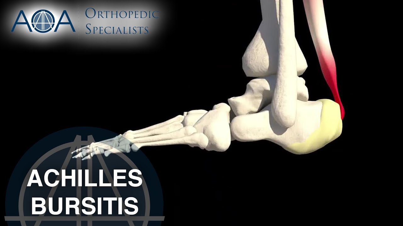 AOA Orthopedic Specialists - Achilles Bursitis