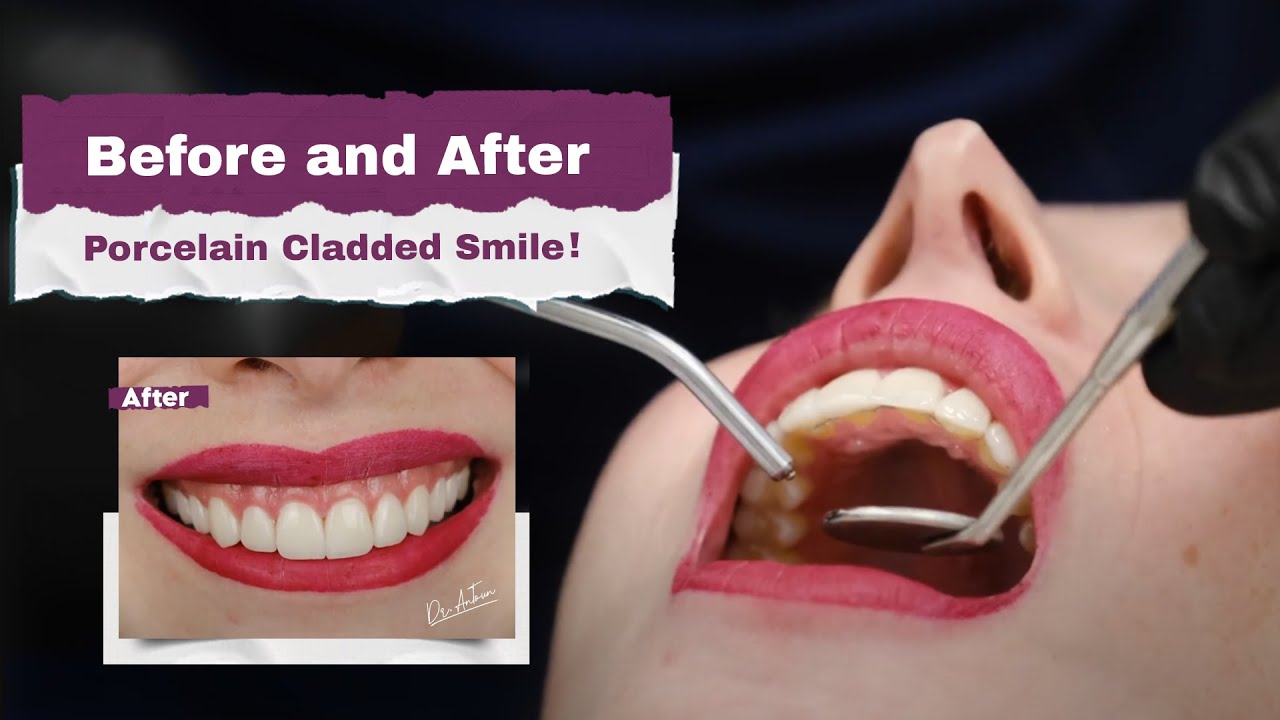 Porcelain Veneers Will Upgrade Your Smiling Game