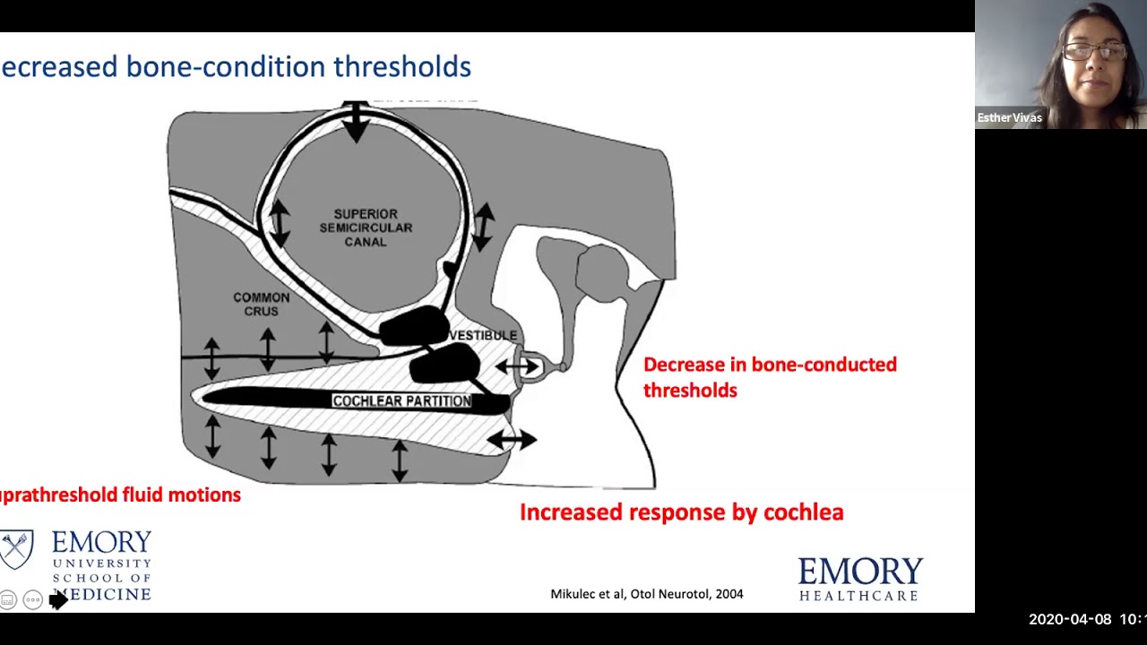 Condictive hearing loss: it's not always otosclerosis - Dr. Esther Vivas