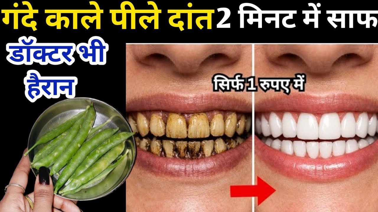सिर्फ 1 रूपये में गंदे सड़े पीले दांतों को मोती की तरह चमका देगा /Teeth whitening remedy