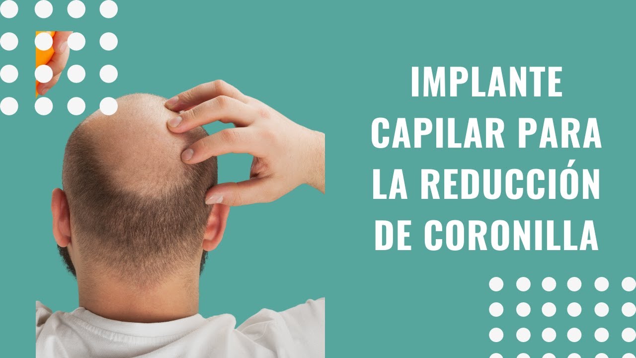 Implante capilar reducción de coronilla