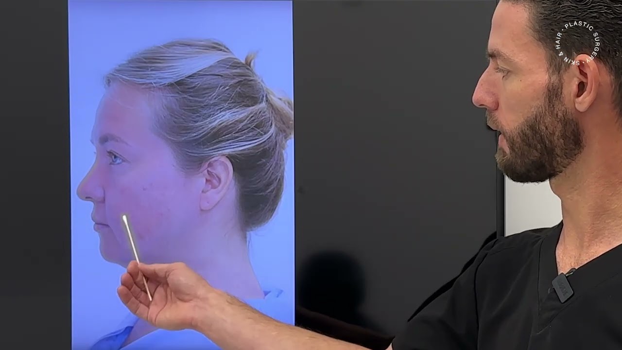 The importance of dissolving fillers before facelift surgery