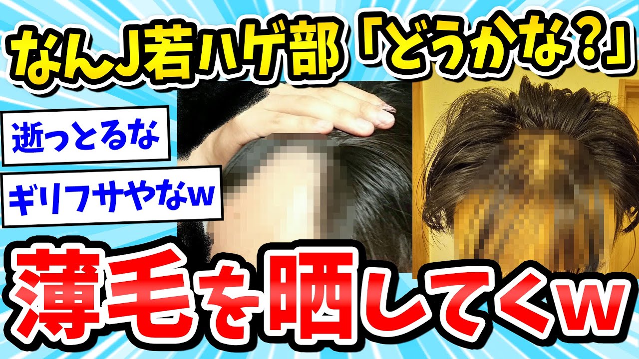 【2ch面白いスレ】なんJ若ハゲ部ワイ(20)、こっからはげ回避できるか判断してくれ→結果ｗｗｗ【ゆっくり解説】
