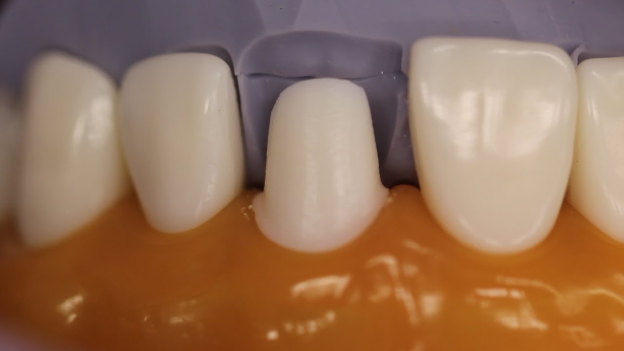 PFM Anterior Tooth Preparation
