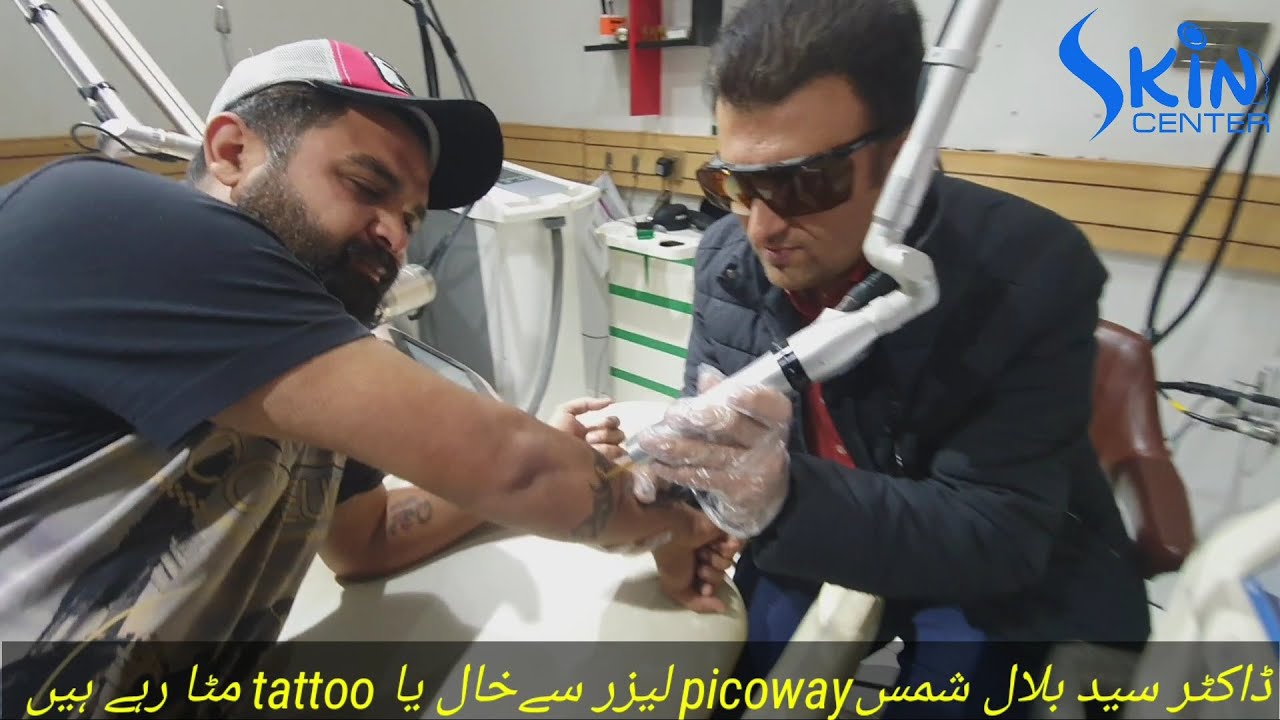 Tattoo removal by picoway laser candela by dermatologist Dr syed Bilal Shams