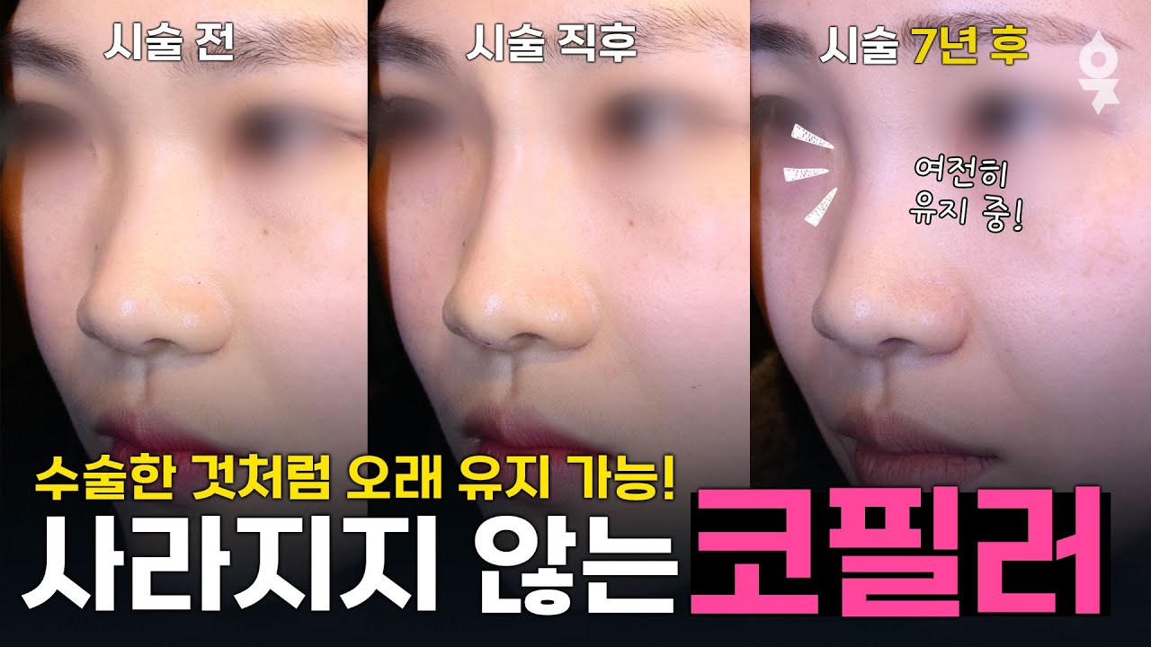 수술 없이 코가 예뻐지는 가장 좋은 방법! 코필러 추천하는 이유