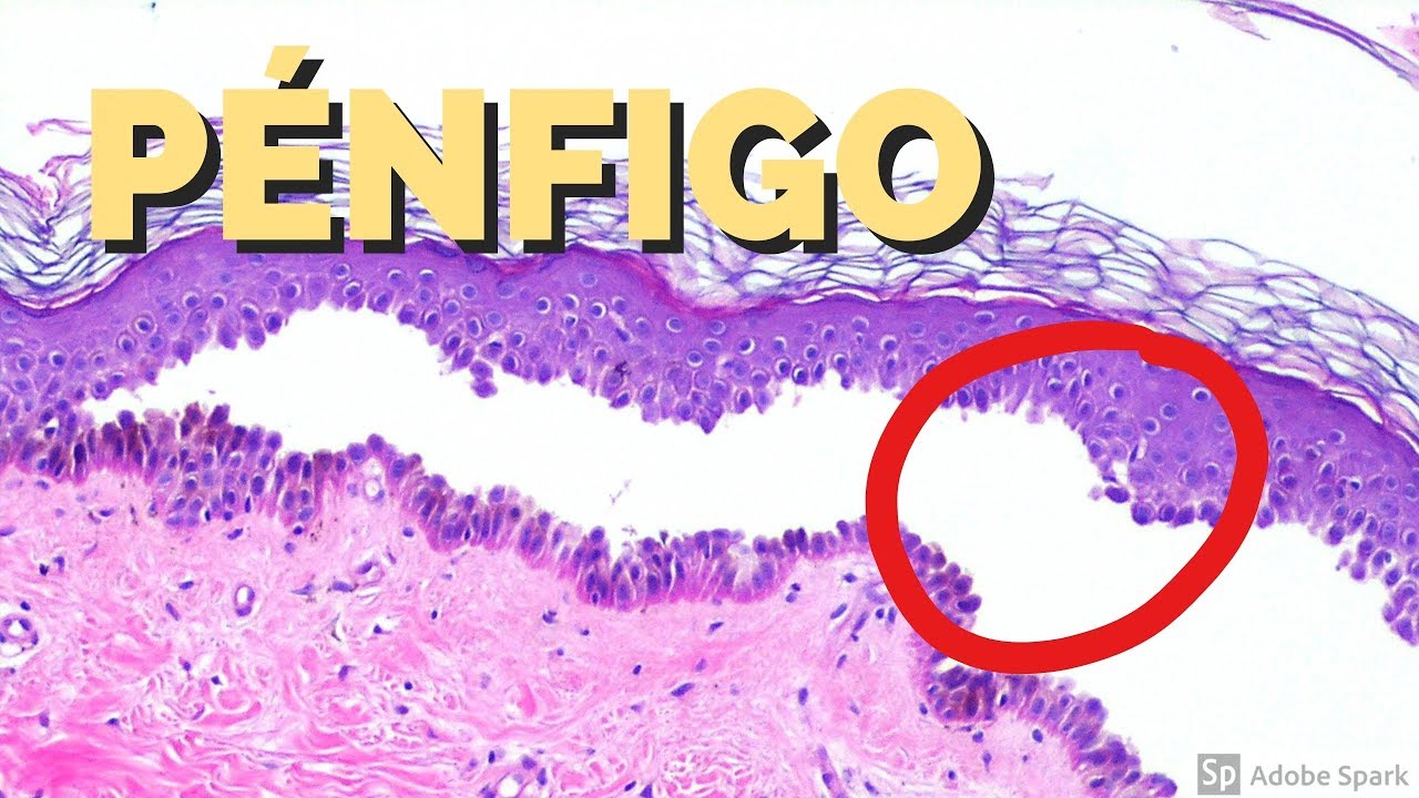 Dermatología: Pénfigo vulgar y foliáceo