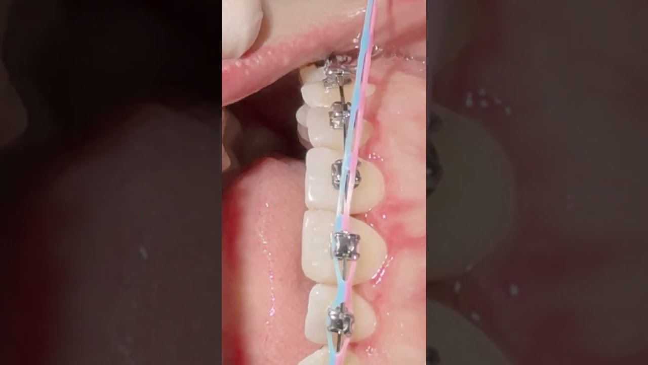 🩷🩵😍 Placing on elastic power chain #orthodontics #bracescolors #braces