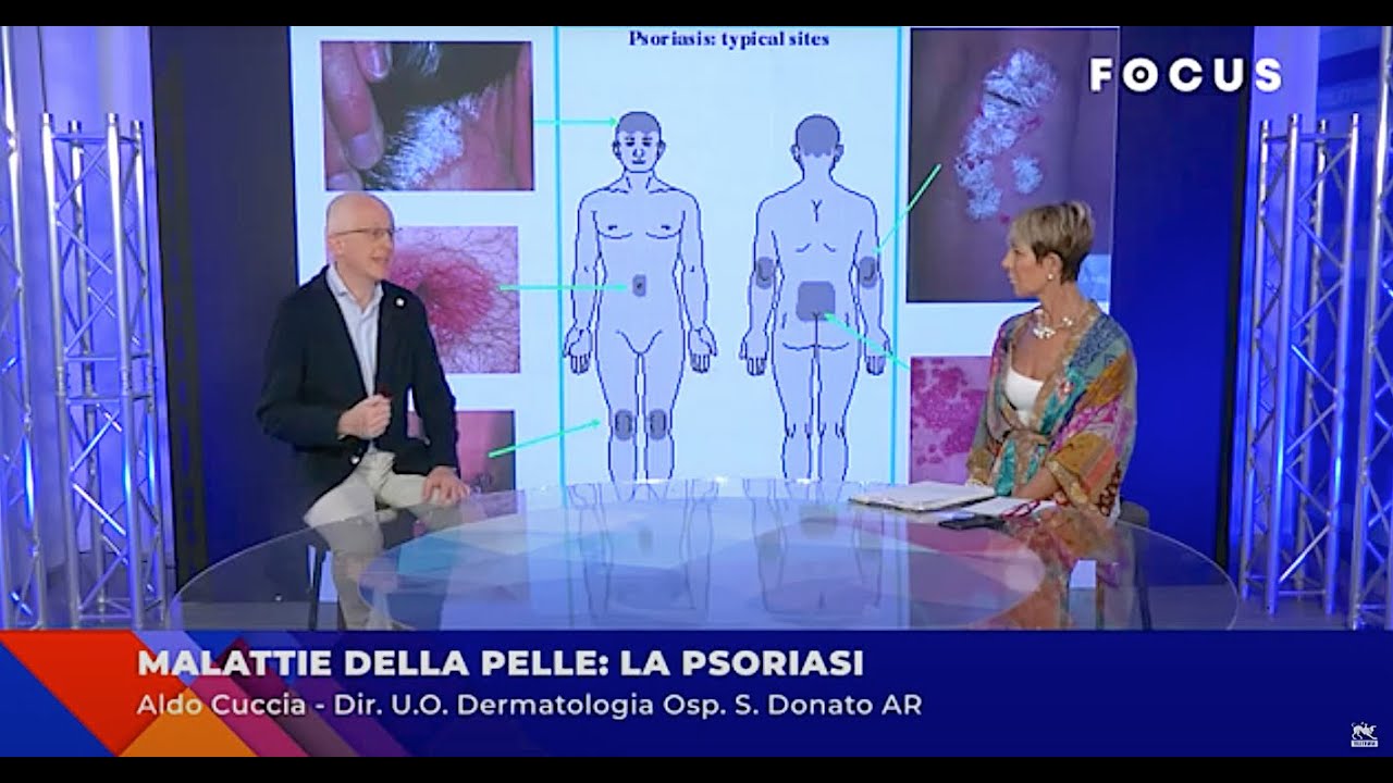 Malattie della pelle: la psoriasi