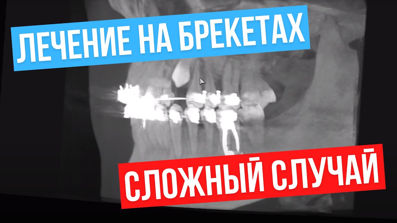 Лечение на брекетах. Клык застрял в челюсти.