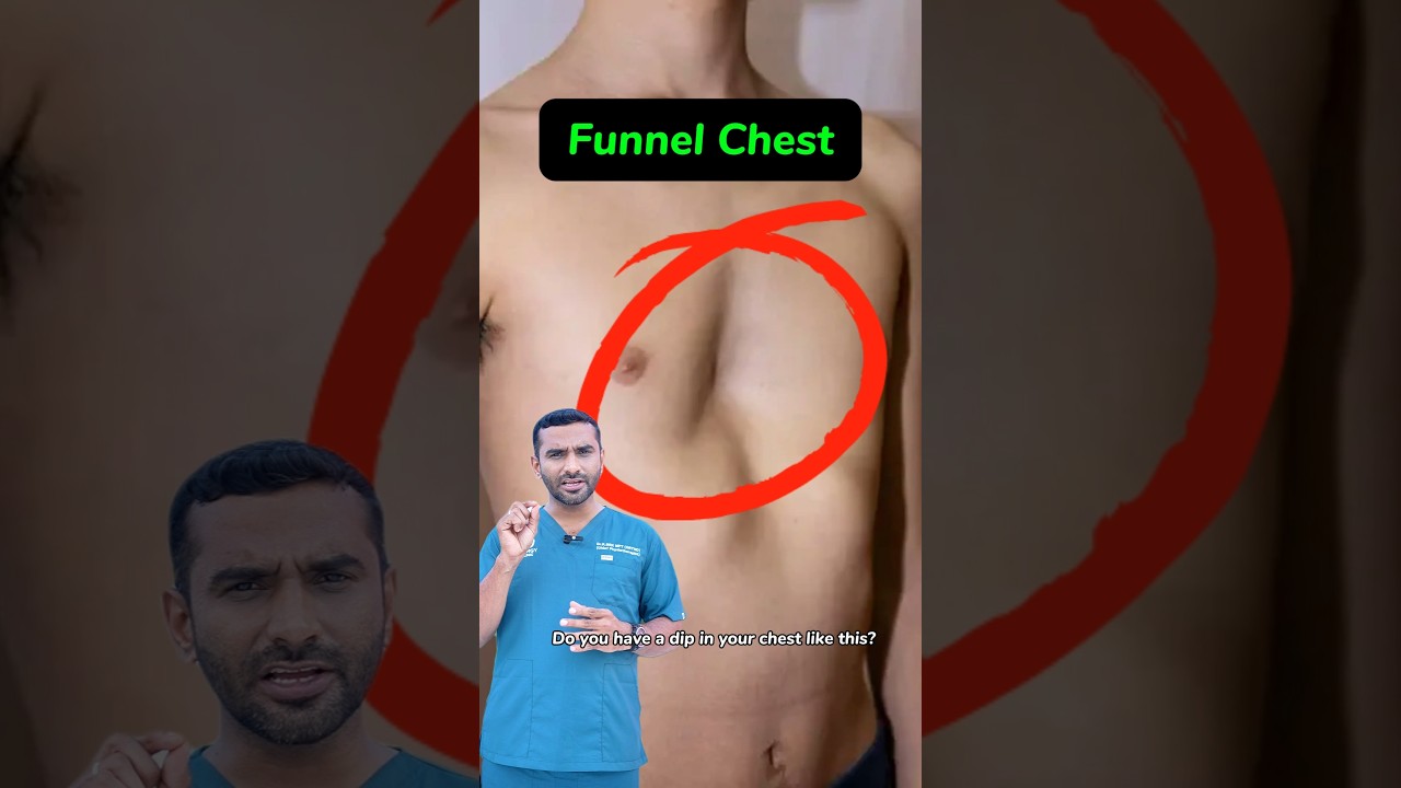 Pectus Excavatum &ndash; Can Exercise Fix It? | funnel chest | energyclinic