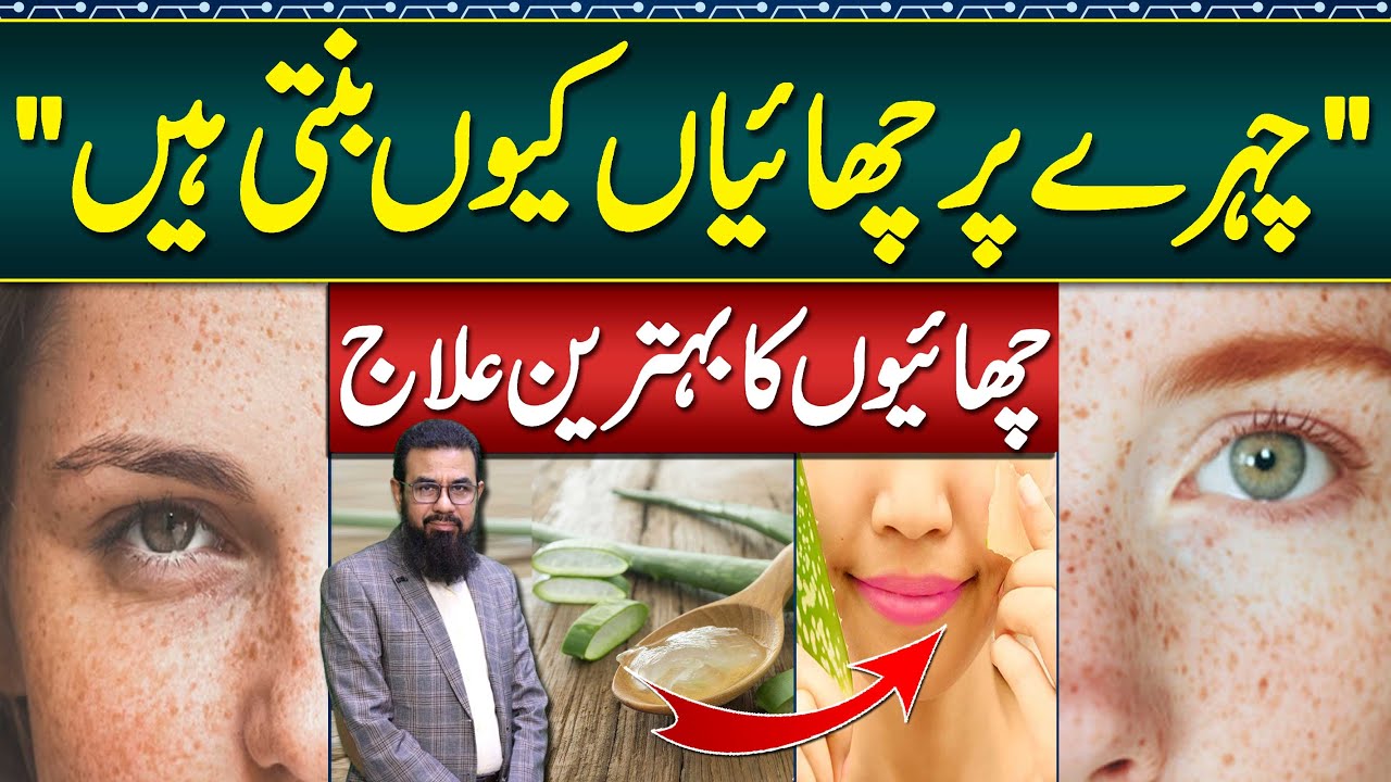 Melasma Treatment at Home - Melasma Cream and Melasma Home Remedies -  Face Par Chaiyan Ka Ilaj