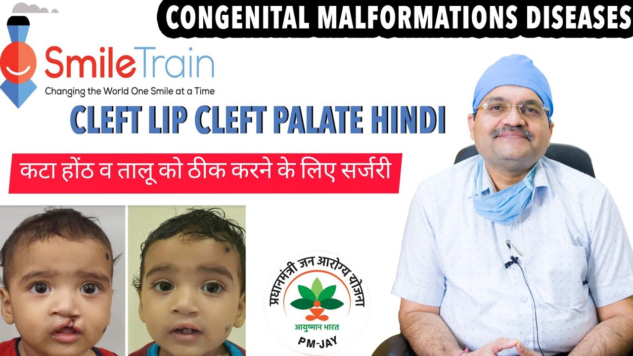 कटा होंठ व तालू - Cleft Lip and Palate के साथ जन्मे 2000 बच्चों की लौटी मुस्कान | Lakecity Hospital