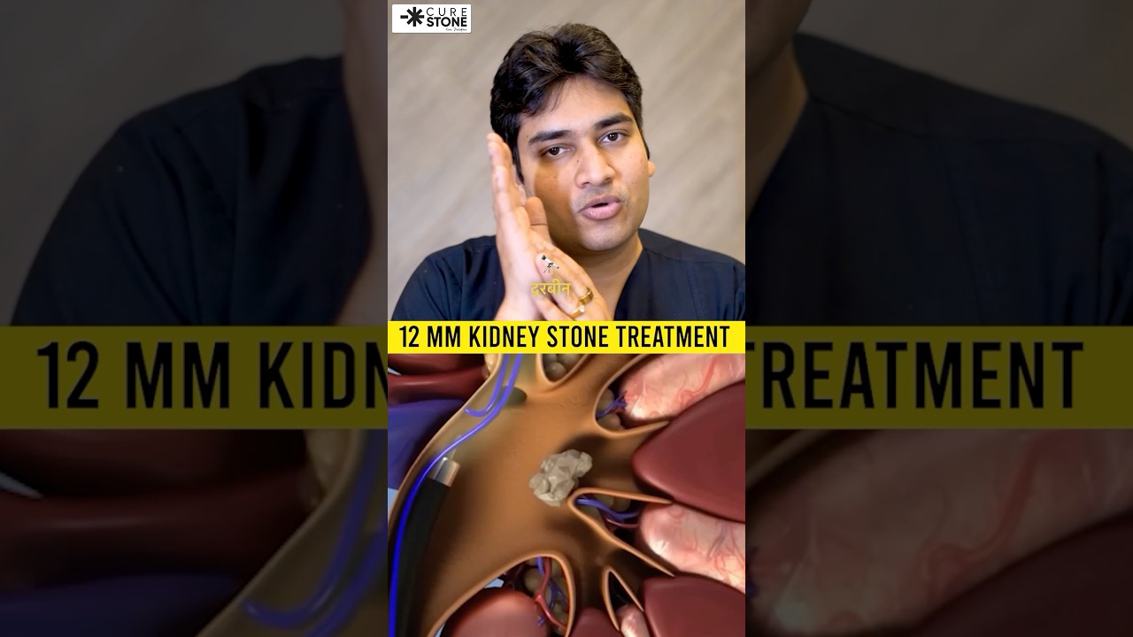 12 mm Kidney stone treatment | RIRS | How kidney stones are removed #rirs