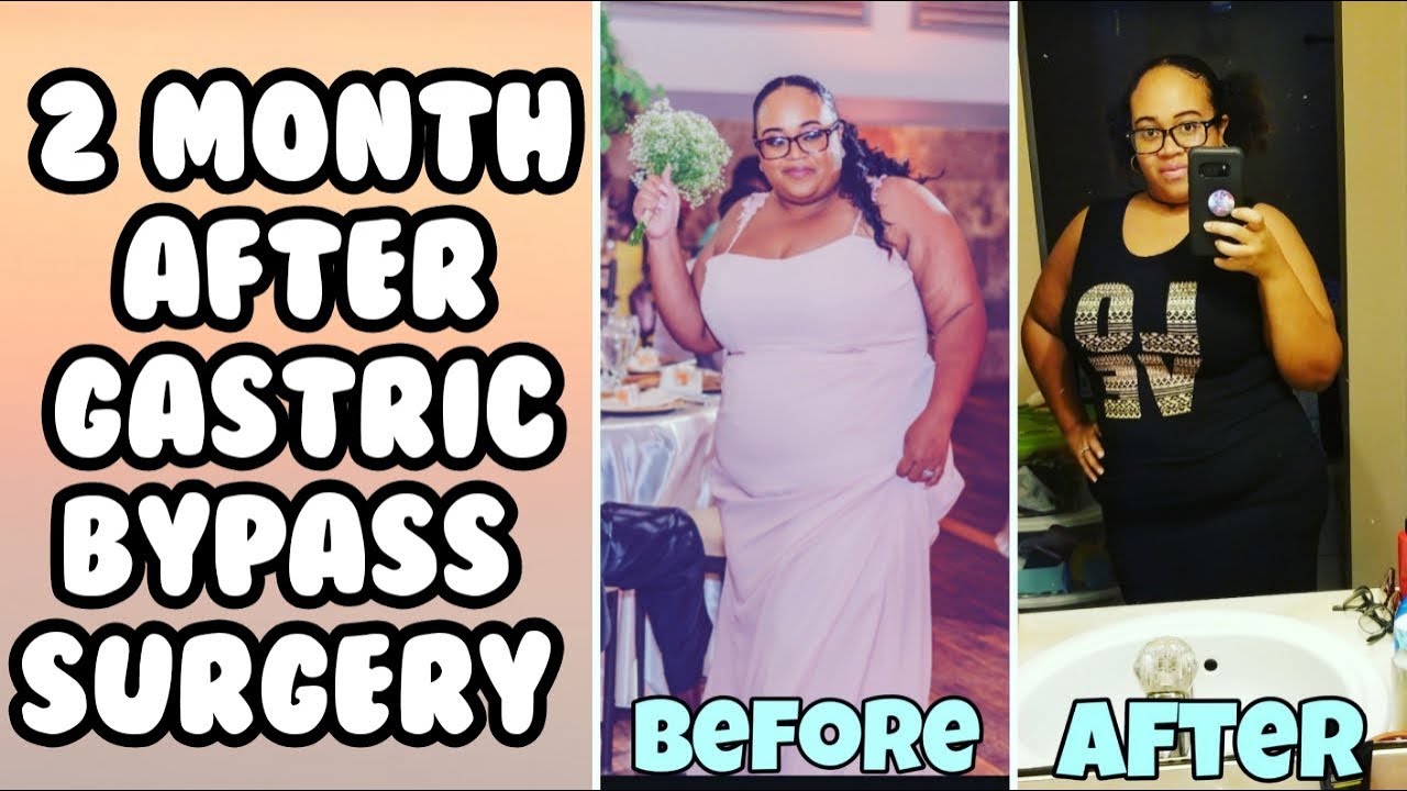 2 Month After Gastric Bypass Surgery