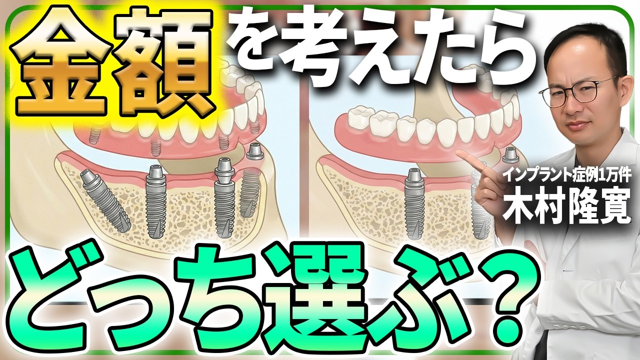 オールオン４とインプラントオーバーデンチャーはどちらが安い？歯医者がオールオン４が優れている点や逆に入れ歯を選んだ人のリアルなど解説します