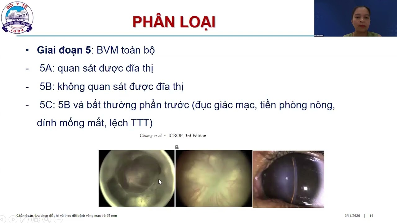 Bài giảng: Chẩn đoán, lựa chọn điều trị và theo dõi bệnh Võng mạc trẻ đẻ non (VMTĐN)
