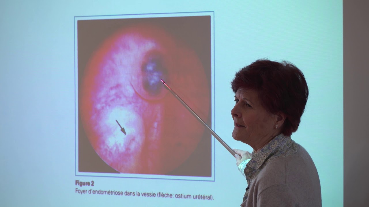 Traitements naturels de l'endométriose et des ovaires polykystiques lors de désir de grossesse