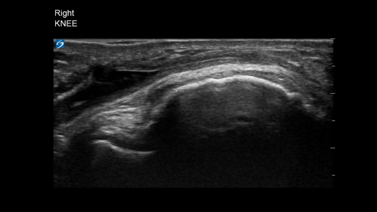 Knee Ultrasound: Infrapatellar Bursitis Aspiration (Part 3)