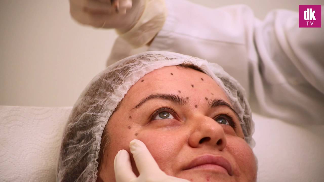 Botoks Uygulaması | Antalya | DK Klinik