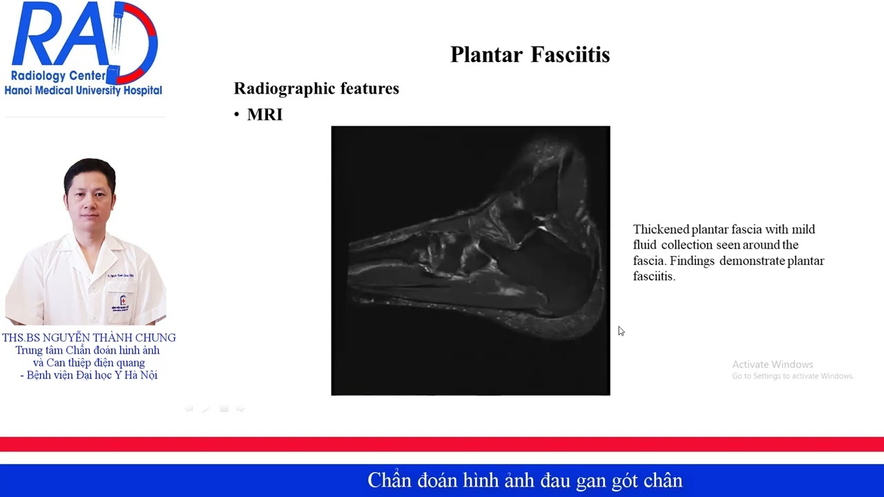CHẨN ĐOÁN HÌNH ẢNH ĐAU GAN GÓT CHÂN