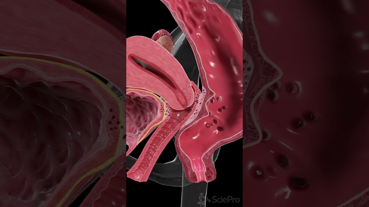 Endometriosis Beyond the Uterus | 3D Animation