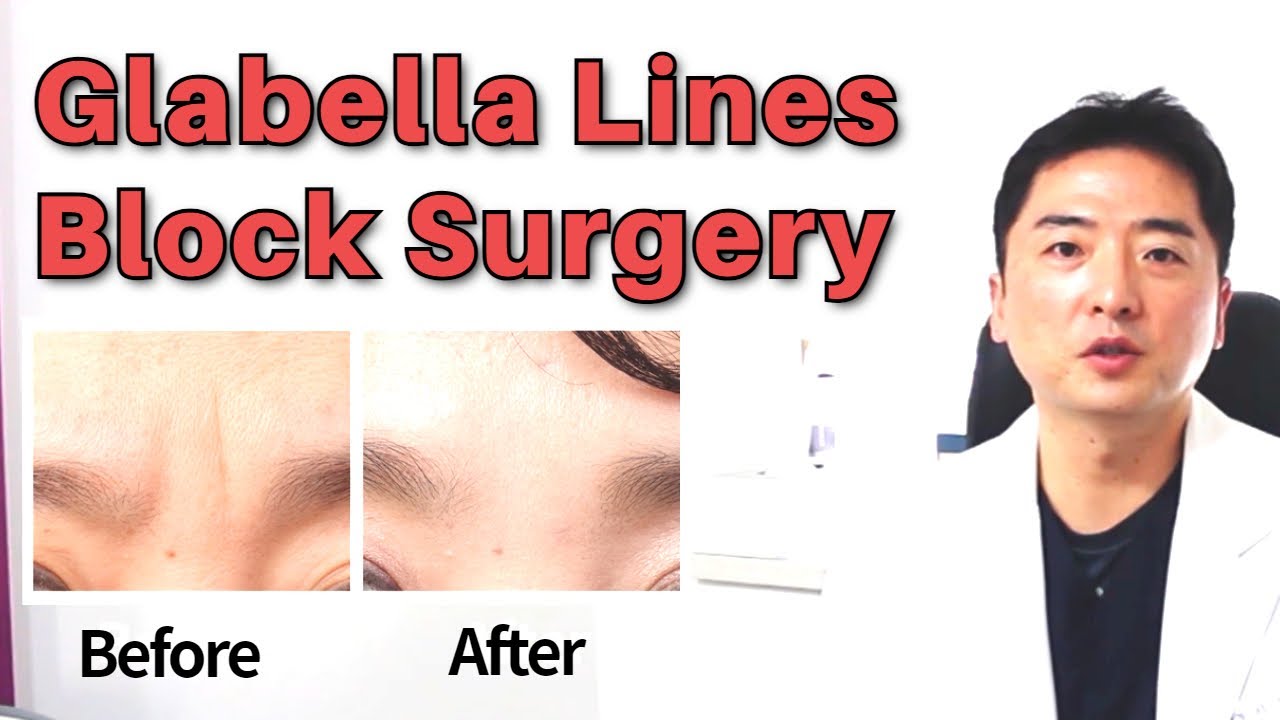 Glabella lines block surgery - Special wrinkle surgery, secrte to the younger face!