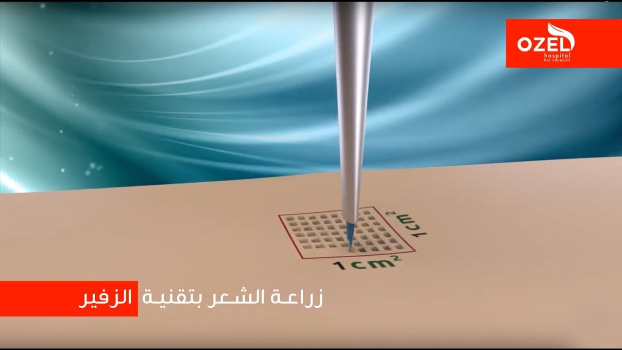 كيف تتم عملية زراعة الشعر بتقنية الزفير SAPPHIRE