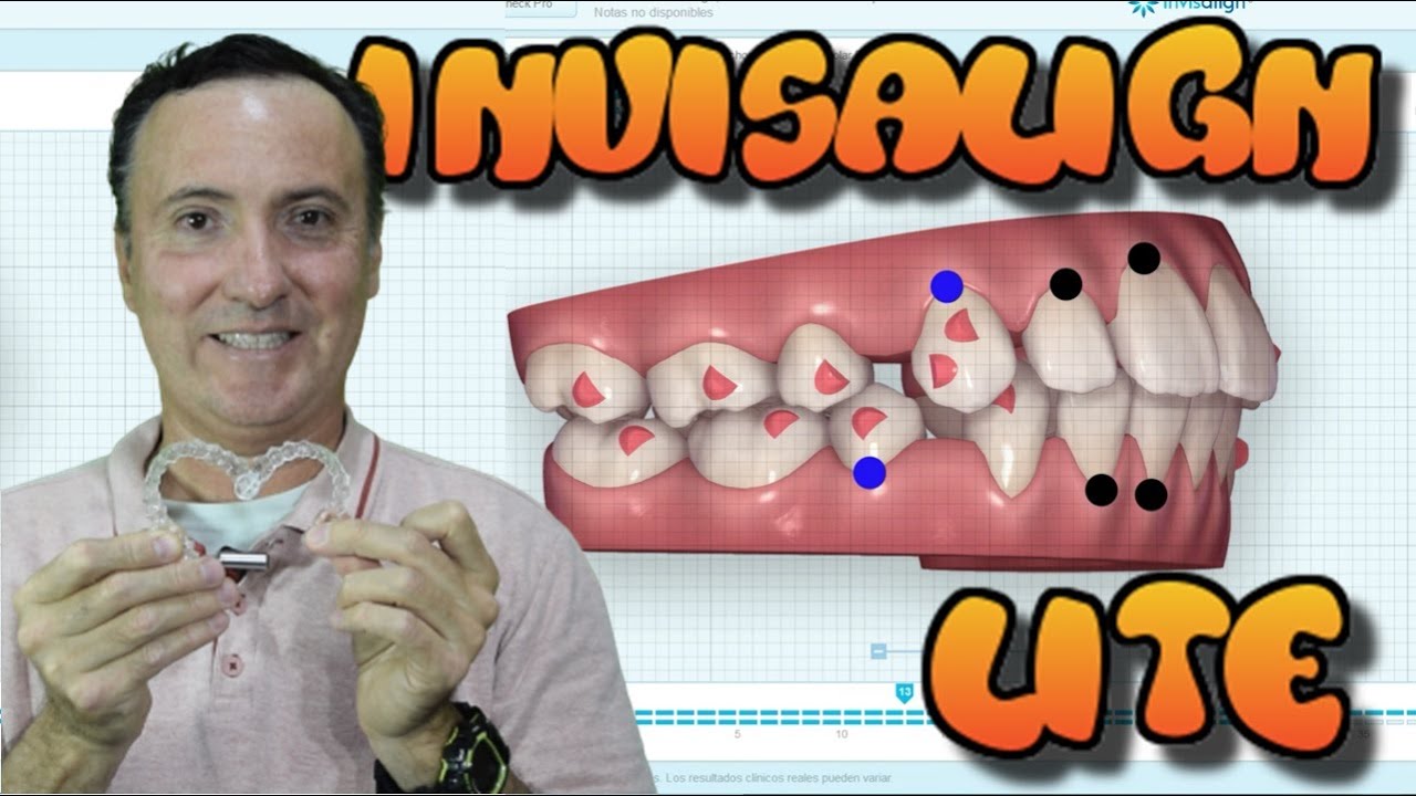 Invisalign Lite