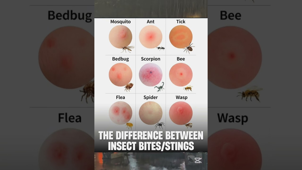 Inset bites vs Stings 