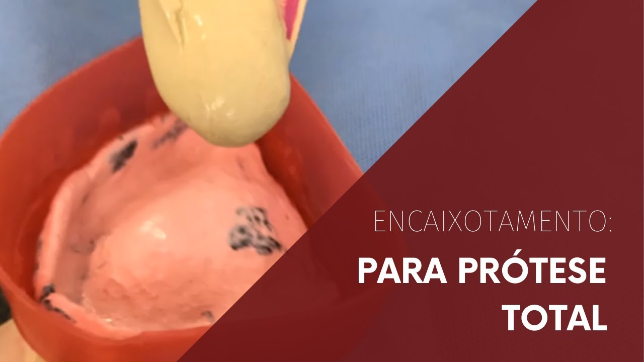 Encaixotamento para Pr&oacute;tese Total
