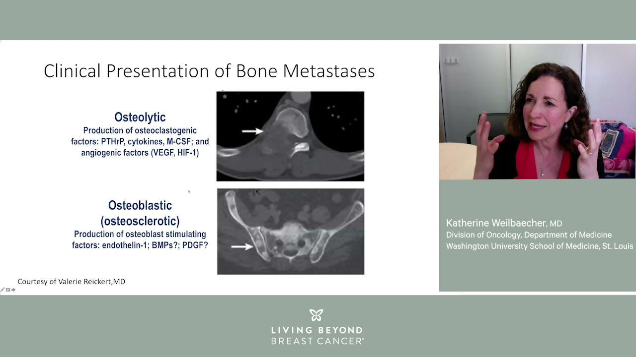 Bone mets