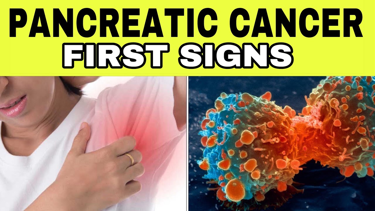 7 Early Signs of PANCREATIC CANCER (Symptoms of Insulinoma)
