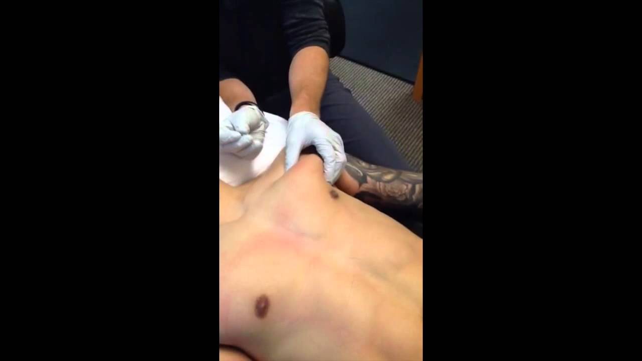 Pec major DN