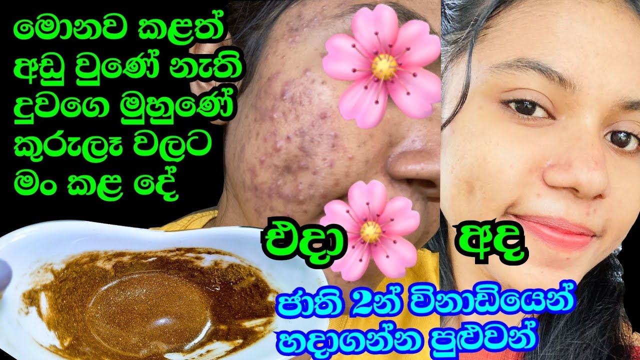 කැතම කැත වුණු දුවගෙ මූණ ජාති 2න් ලේසියෙන්ම මං ලස්සන කළ විදිය  Pimple Treatment Kusala Simple Life ❤❤