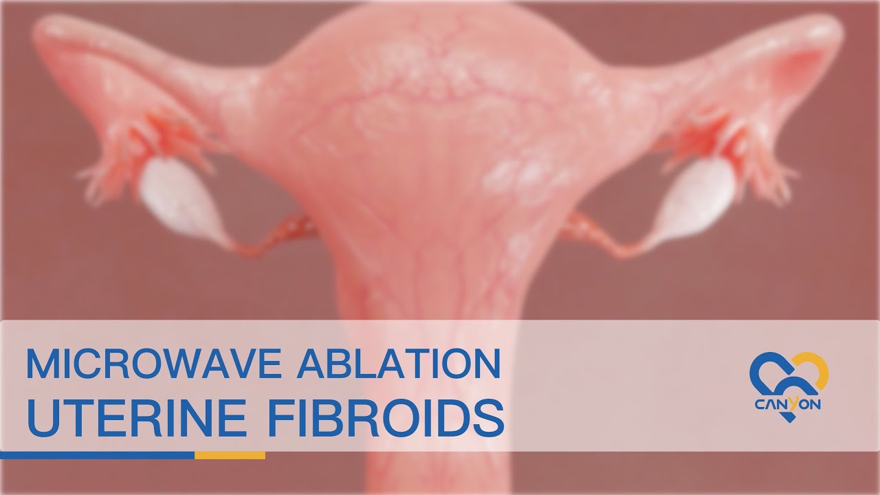 Microwave Ablation of Uterine Fibroids - Animation
