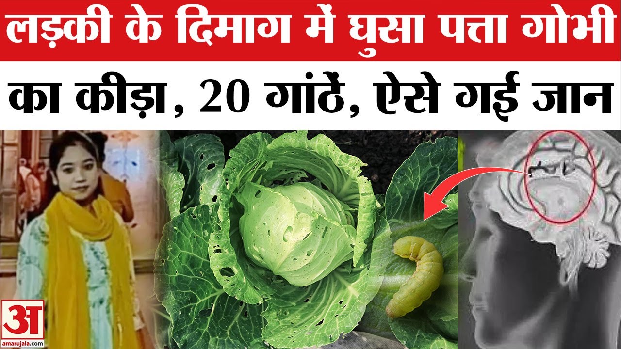 Fast Food Burger खाने से Amroha की लड़की के Brain में पहुंचा कीड़ा, ऐसे गई जान | UP Latest News