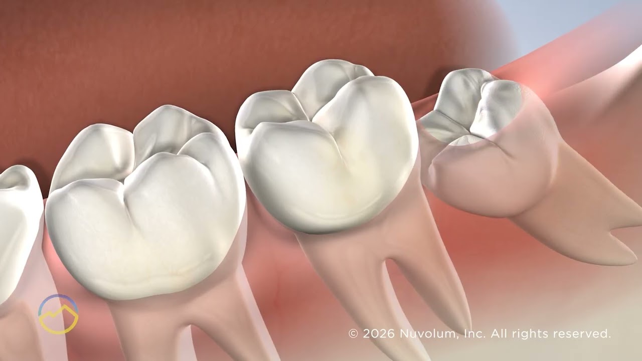Wisdom Teeth Removal in El Dorado Hills, CA