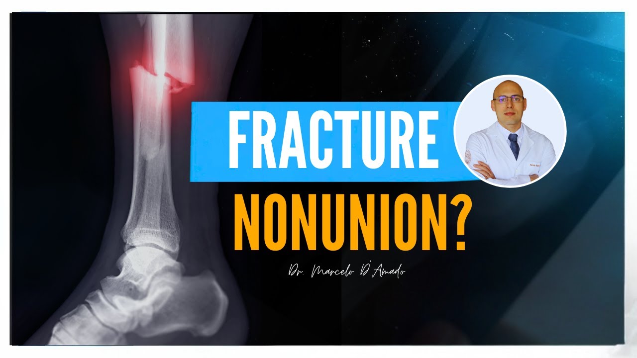 Your Fracture Won't Heal? Understand Pseudoarthrosis and How to Treat It!