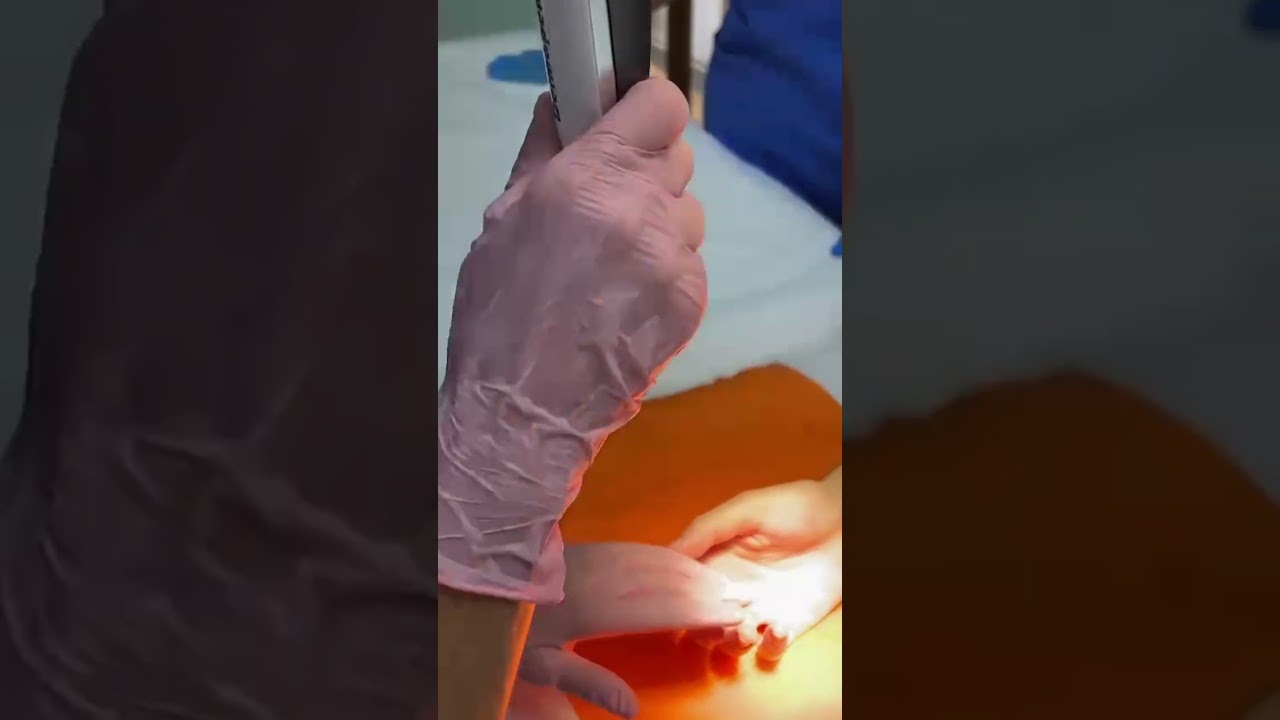 Il trattamento di iperidrosi delle mani con tossina botulinica - Dott.ssa Marina Conese